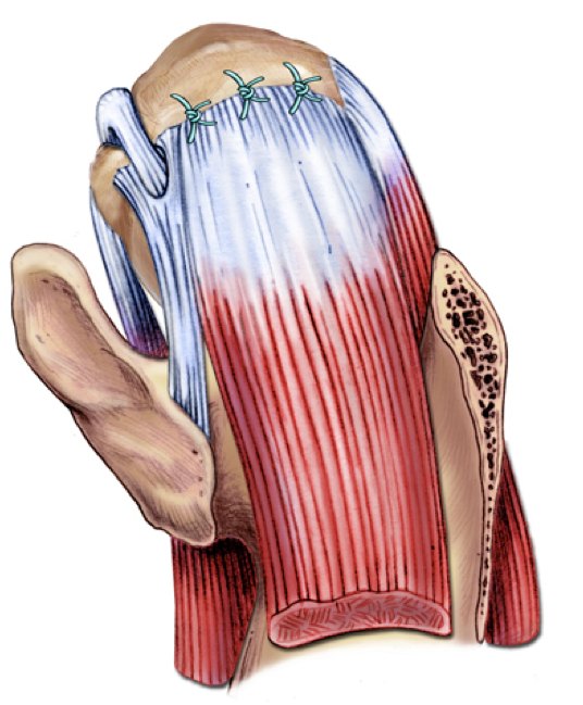 Illustration of a repaired rotator cuff.