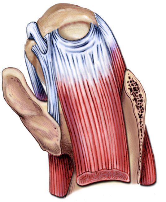 Illustration of a rotator cuff tear.