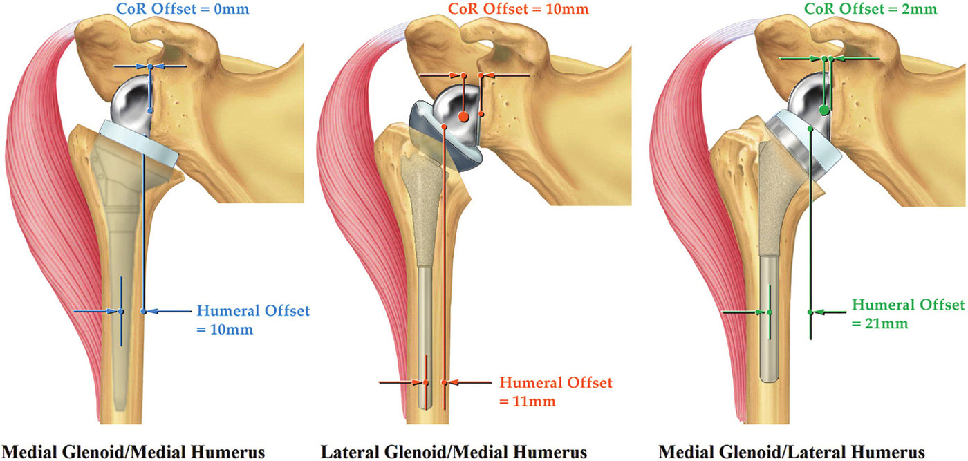 Three reverse shoulder replacements side by side. In each, a metal ball is fixed to the shoulder blade and a cup sits on the top of the arm bone, but the parts are positioned differently, so the joint sits at a different distance from the shoulder blade and from the arm bone.