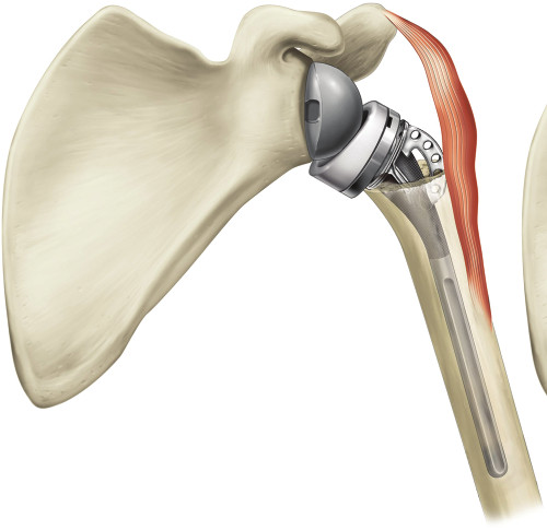 A reverse shoulder replacement used to treat a broken shoulder. A metal ball is fixed to the socket of the shoulder blade and a cup on a stem sits in the top of the arm bone.