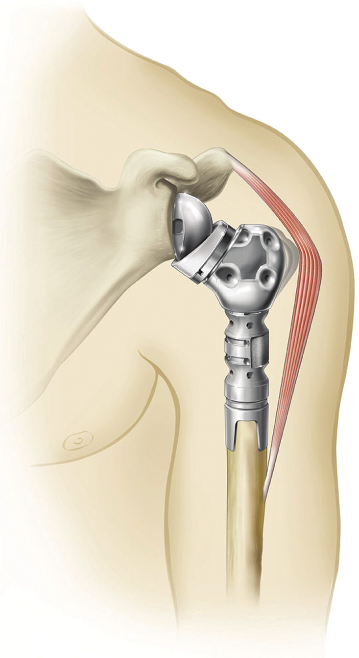 A humeral reconstruction prosthesis in place. A metal ball is fixed to the shoulder blade, and a segmented metal stem replaces the missing upper part of the arm bone, carrying the cup that articulates with the ball.