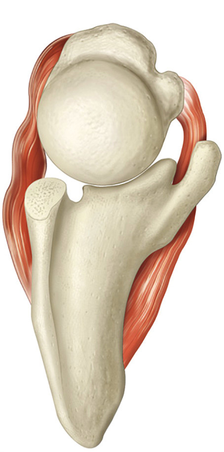The same axial view of a shoulder in which the back of the socket has eroded, so the ball has shifted backward into the worn area.