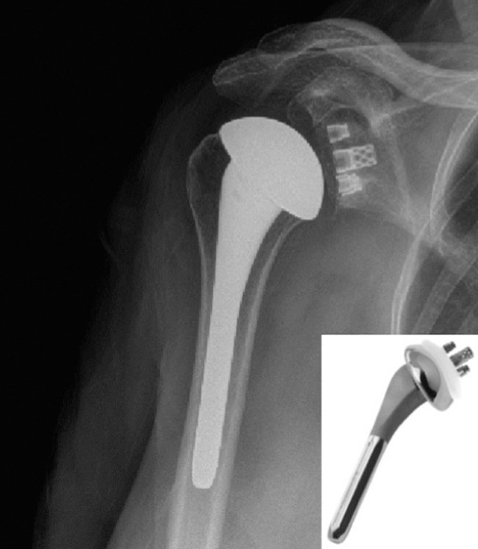 An X-ray of a shoulder after an anatomic replacement. A smooth metal ball sits at the top of the arm bone on a stem running down inside it, and small markers show the new socket fitted to the shoulder blade. An inset photograph shows the implant itself.